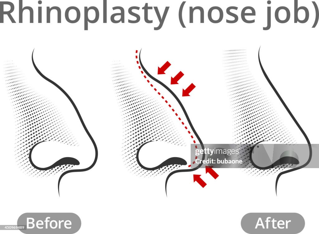Human Nose Job Before & After