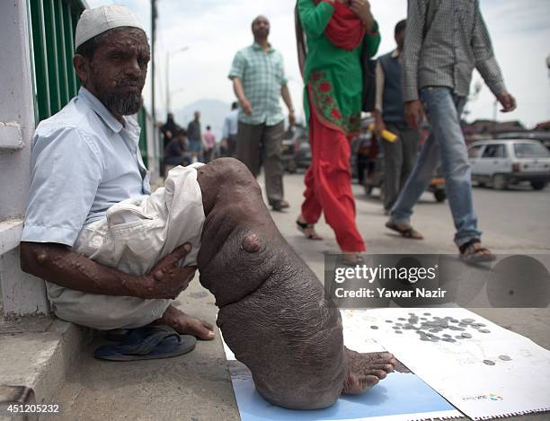 An Indian beggar Sahajul Sheikh, with the rare condition Human Papilloma Virus, begs on a roadside on June 25, 2014 in Srinagar, the summer capital...