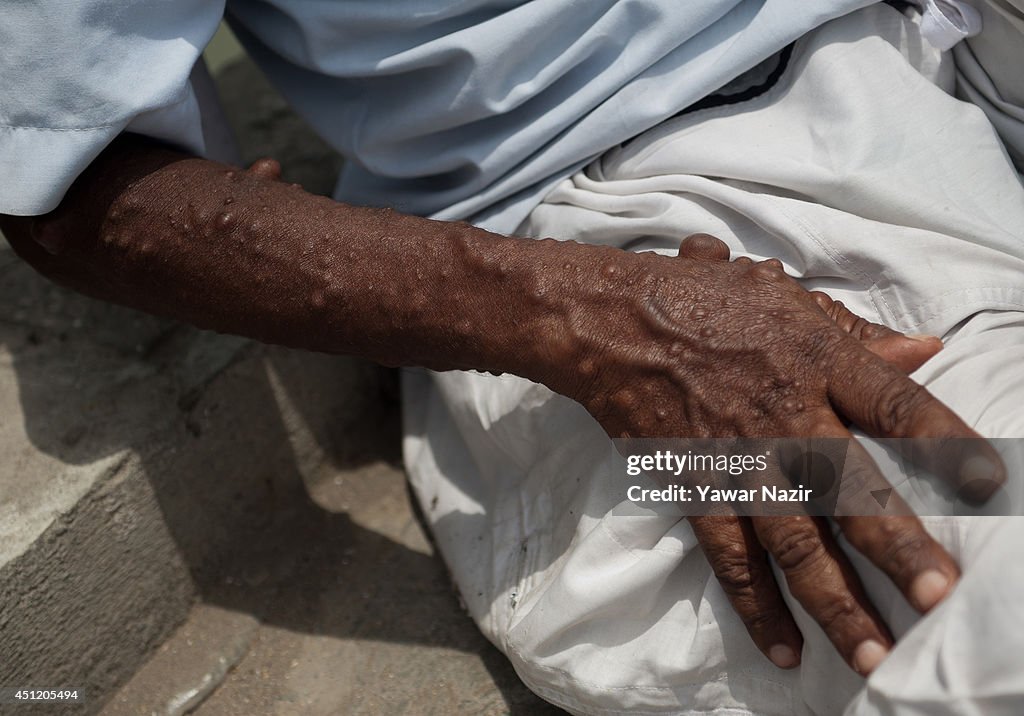 Man With Rare Disease Begs For Living In Kashmir