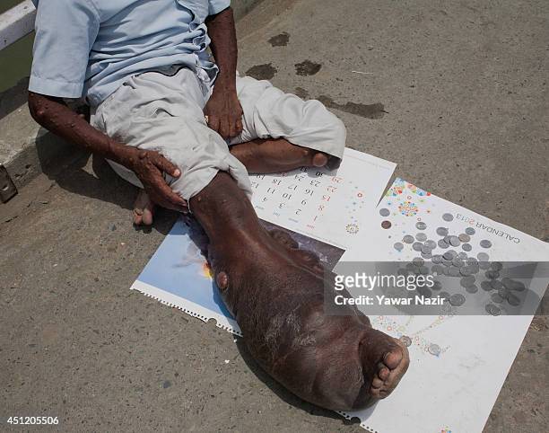 An Indian beggar Sahajul Sheikh, with the rare condition Human Papilloma Virus, begs on a roadside on June 25, 2014 in Srinagar, the summer capital...