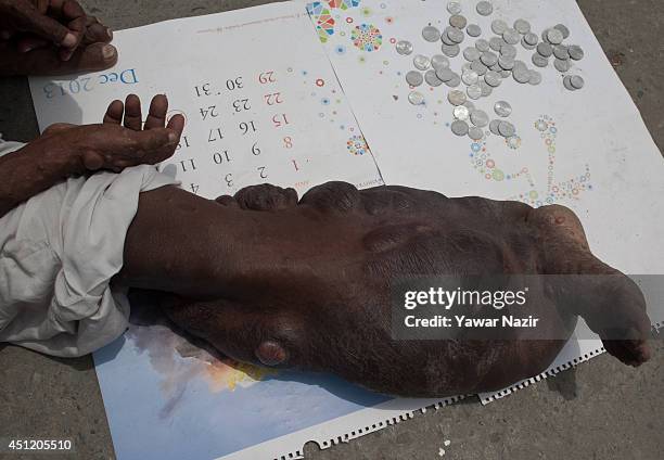 An Indian beggar Sahajul Sheikh, with the rare condition Human Papilloma Virus, begs on a roadside on June 25, 2014 in Srinagar, the summer capital...