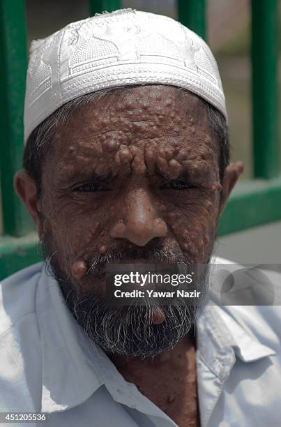 An Indian beggar Sahajul Sheikh, with the rare condition Human Papilloma Virus, begs on a roadside on June 25, 2014 in Srinagar, the summer capital...