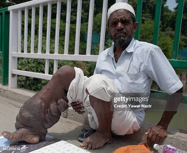 An Indian beggar Sahajul Sheikh, with the rare condition Human Papilloma Virus, begs on a roadside on June 25, 2014 in Srinagar, the summer capital...