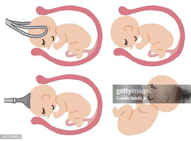 illustrations, cliparts, dessins animés et icônes de forceps et tirettes - forceps
