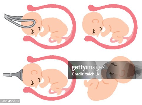 Forceps and pulls Forceps and pulls