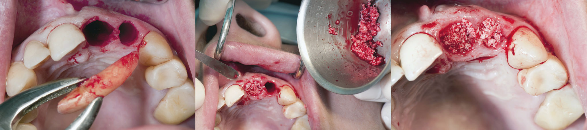 bone graft dental