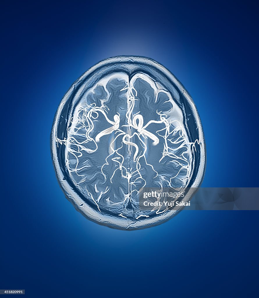 Blood vessel with human brain MRI