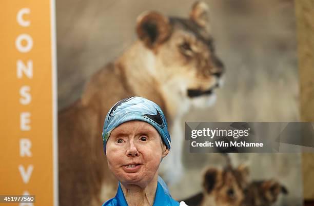 Charla Nash, the victim of a mauling by a pet chimp in Connecticut in 2009 and who underwent a face transplant, speaks at a press conference July 10,...