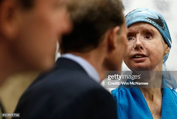 Charla Nash , the victim of a mauling by a pet chimp in Connecticut in 2009 and who underwent a face transplant, speaks at a press conference July...