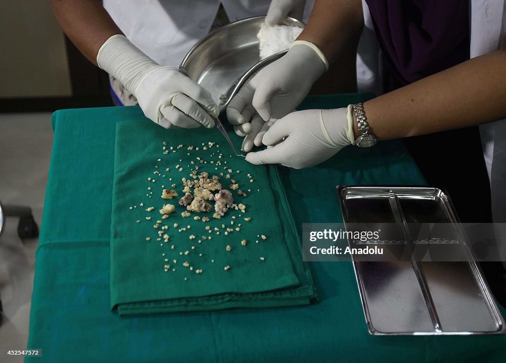Indian teen getting his 232 teeth pulled out in Mumbai