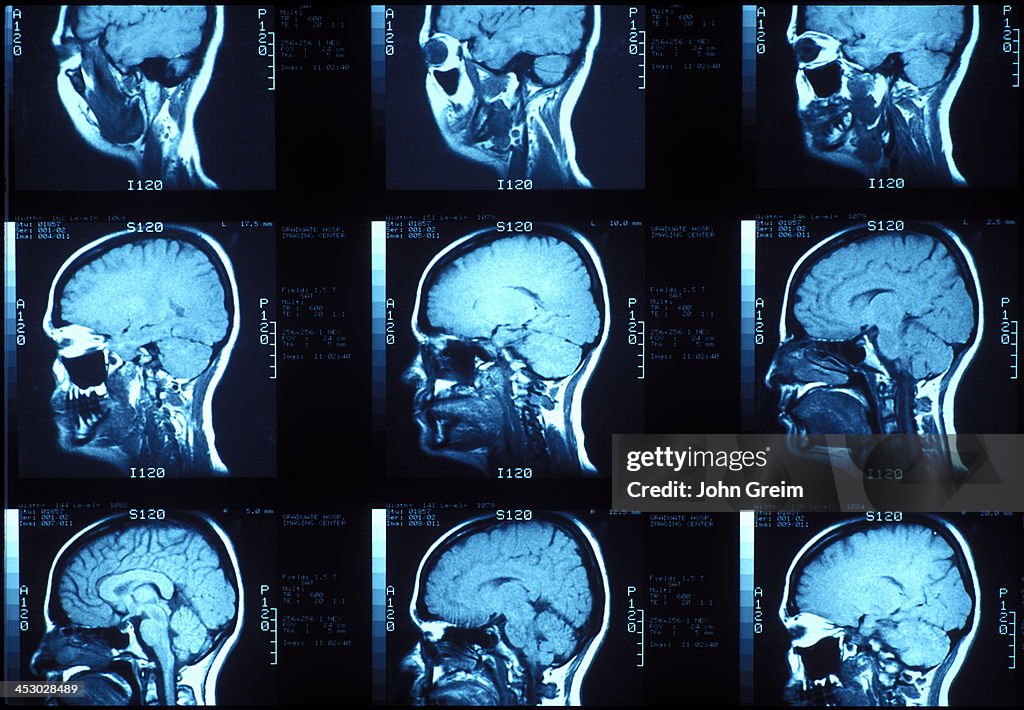 MRI of the lateral skull...