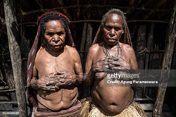 Two women from the Dani tribe show their amputated fingers at Obia Village on August 9, 2014 in Wamena, Papua, Indonesia. The Dani tribe live a...