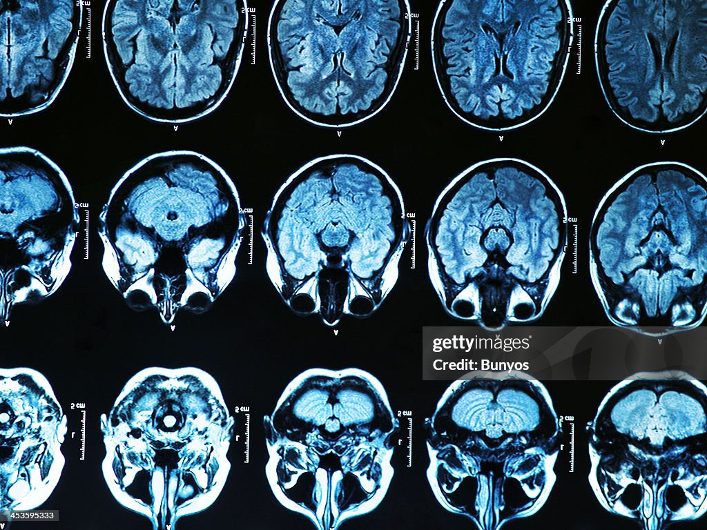 MRI Scan Gehirn