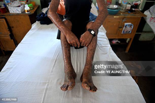 Myanmar-health-leprosy,FEATURE by Kelly Macnamara A patient sits on a bed at the Mawlamyine Christian leprosy hospital in Mawlamyine taken on March...