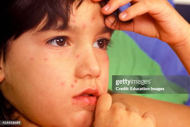 Year, Old Boy With Chicken Pox.