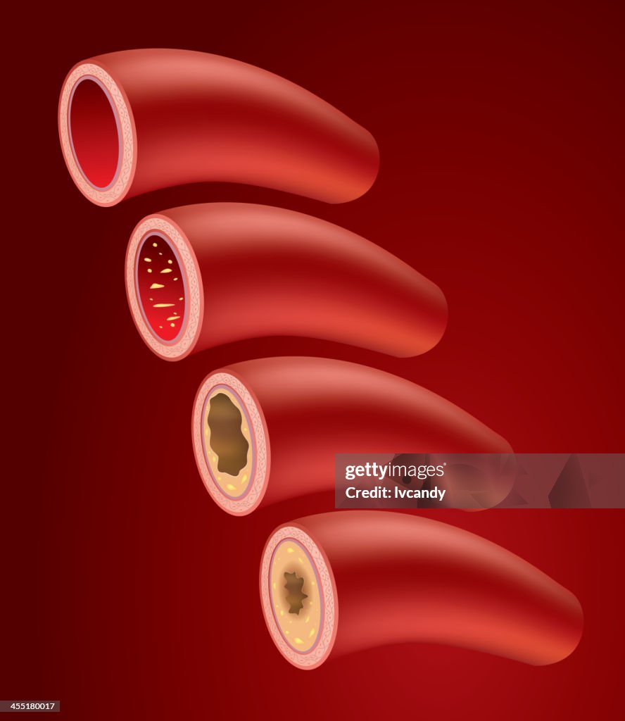 Atherosclerosis