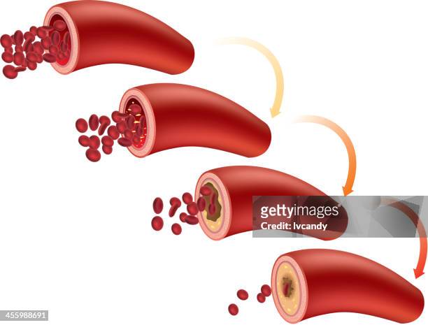 illustrazioni stock, clip art, cartoni animati e icone di tendenza di l'aterosclerosi - sangue umano