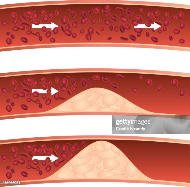 atherosclerosis - atherosclerosis stock illustrations