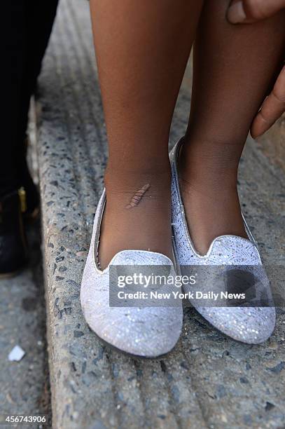 Scar on the foot of four-year-old Jordan from a broken radiator in her apartment. Her mother Tanya Miller said NYCHA's failure to repair broken...