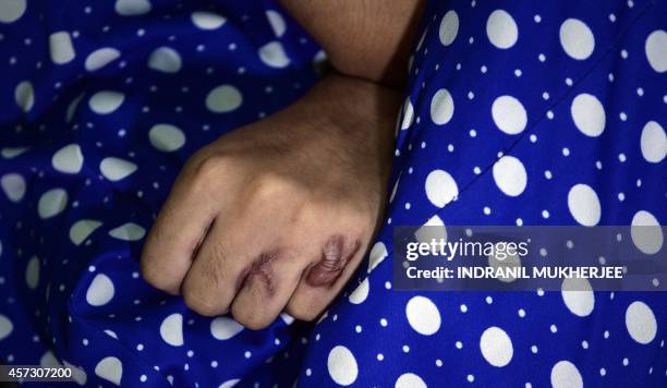 To go with India-rights-women-internet,FOCUS by Rachel O'Brien In this photograph taken on October 10, 2014 burn marks are seen on the hand of Indian...
