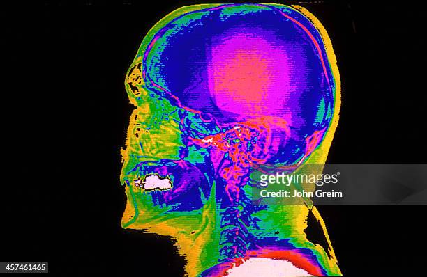 Color CAT scan of the lateral skull.