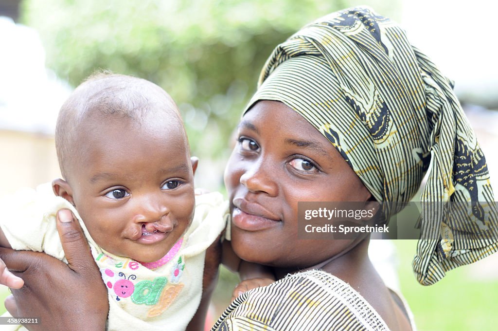 Baby with cleft palate waiting for operation