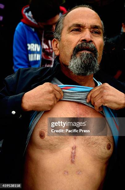 Refugee shows in the camera his scars from the Open Heart SUrgery he had back in Syria and it poses a threat for him. Syrian refugees that live in...