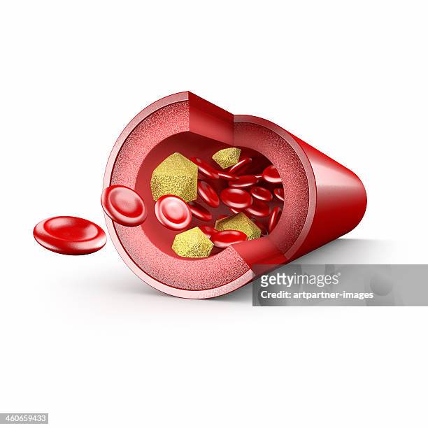 blood vessel with cholesterol deposits on white - cholesterol bildbanksfoton och bilder