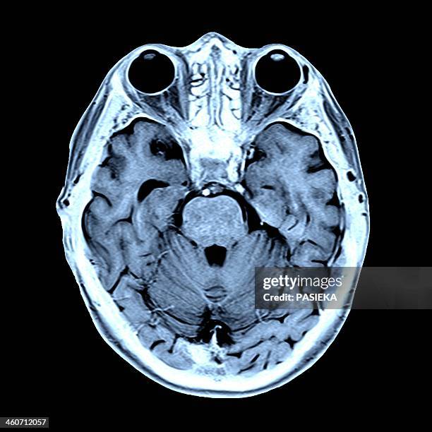 Mri Scan Rch 770 Mri Scan Image High Res Illustrations - Getty Images