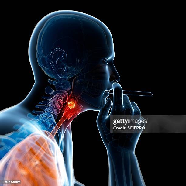 larynx cancer, artwork - larynx stock illustrations