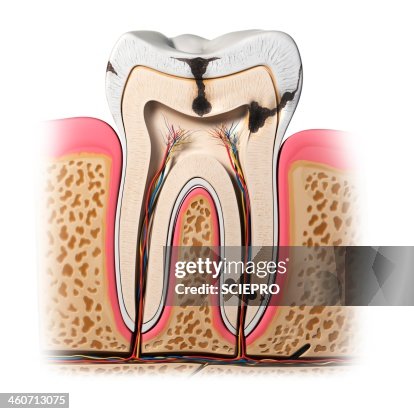 Tooth decay, artwork Tooth decay, artwork