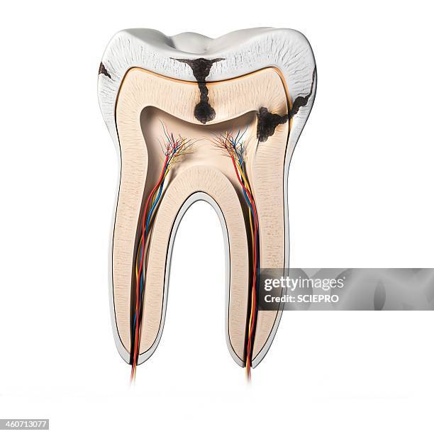 tooth decay, artwork - root canal stock illustrations