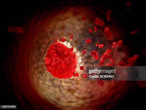 arteriosclerosis, artwork - atherosklerose stock-grafiken, -clipart, -cartoons und -symbole