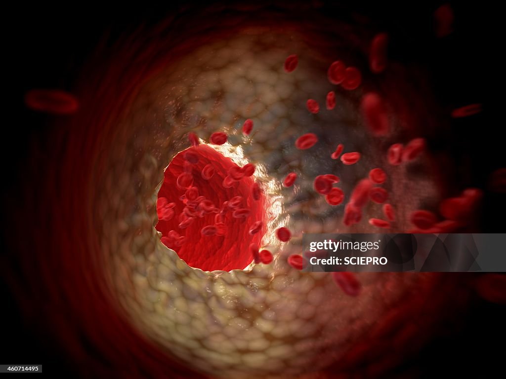 Arteriosclerosis, artwork