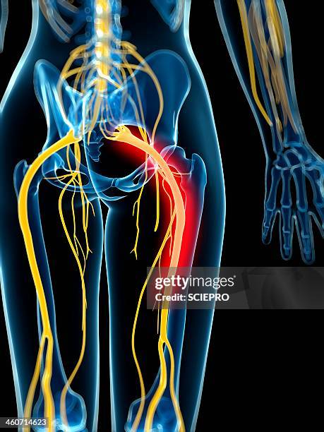 ilustrações de stock, clip art, desenhos animados e ícones de painful sciatic nerve, artwork - ciática