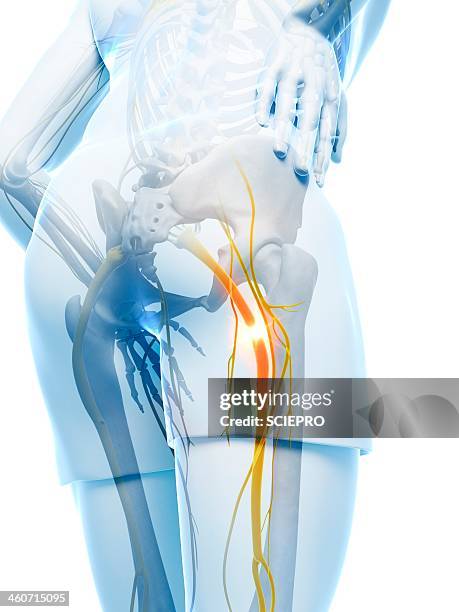 ilustraciones, imágenes clip art, dibujos animados e iconos de stock de painful sciatic nerve, artwork - sciatic