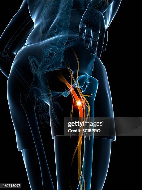 ilustraciones, imágenes clip art, dibujos animados e iconos de stock de painful sciatic nerve, artwork - sciatic