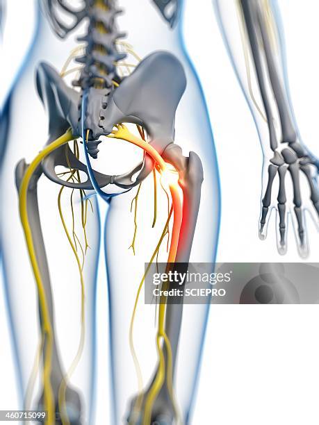 ilustraciones, imágenes clip art, dibujos animados e iconos de stock de painful sciatic nerve, artwork - sciatic