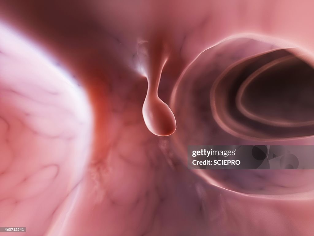 Polype Photo Colon Polyp Artwork High-Res Vector Graphic - Getty Images