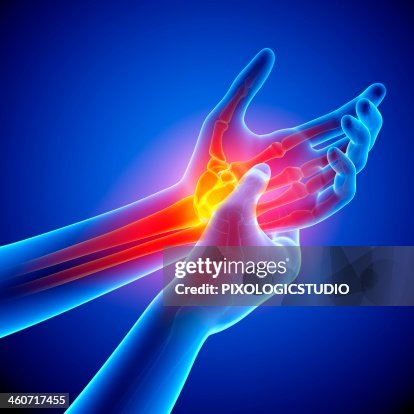 Wrist pain, artwork Wrist pain, artwork