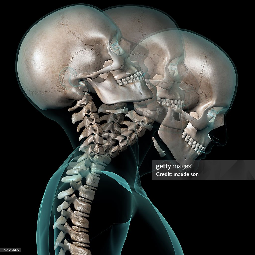 Neck Contortion Xray Of Human Head Showing Neck Contortion High-Res Stock Photo - Getty ...