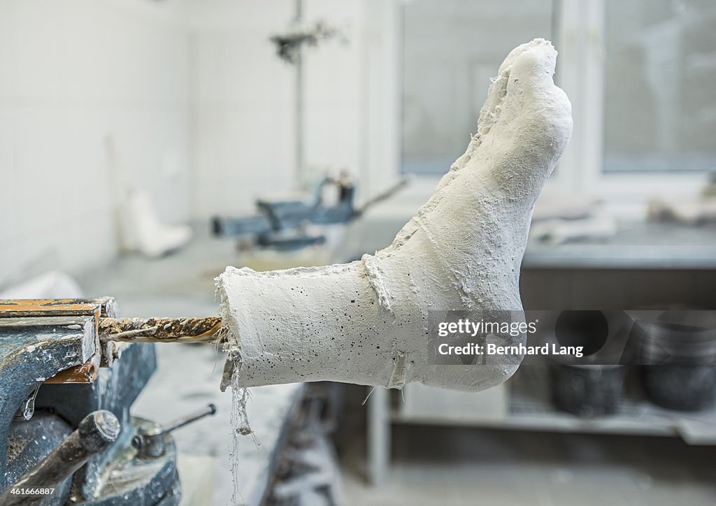 Leg plaster cast in orthopedic workshop