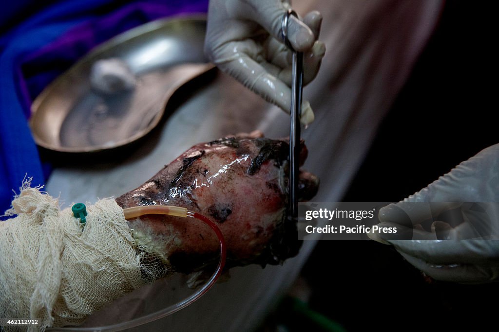 A burnt hand due to arson. At least 40 people have burned in...