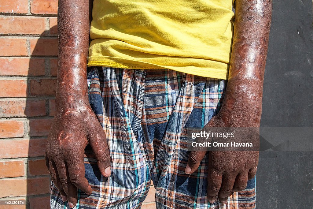 World Leprosy Day 2015