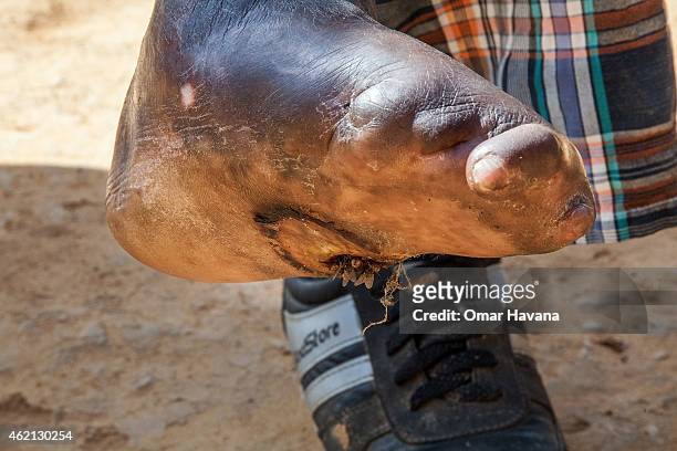 Man affected by leprosy shows an open wound on the sole of his foot on January 24, 2015 in Kathmandu, Nepal. Although prevalence of leprosy in Nepal...