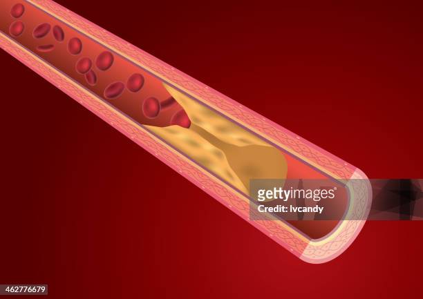 blocked blood vessel - arteries stock illustrations