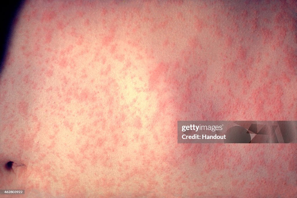 Measles Outbreaks Spread In U.S.