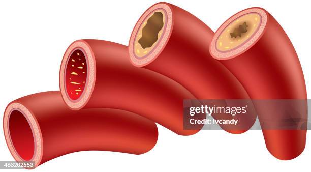 illustrations, cliparts, dessins animés et icônes de athérosclérose - atrésie