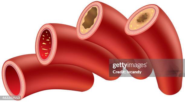 atherosclerosis - atherosclerosis stock illustrations