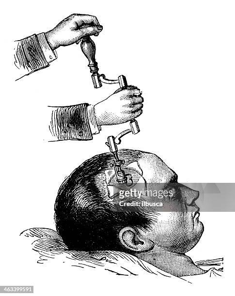 antique medical scientific illustration high-resolution: brain surgery - health history stock illustrations